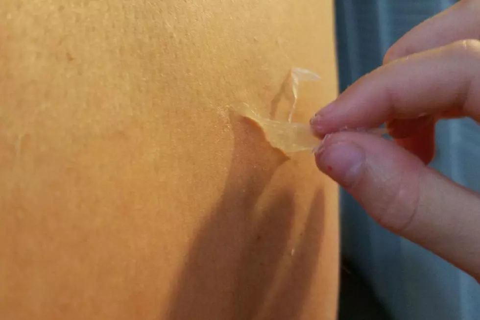 Is It Gross To Let Someone Peel Your Sunburned Skin